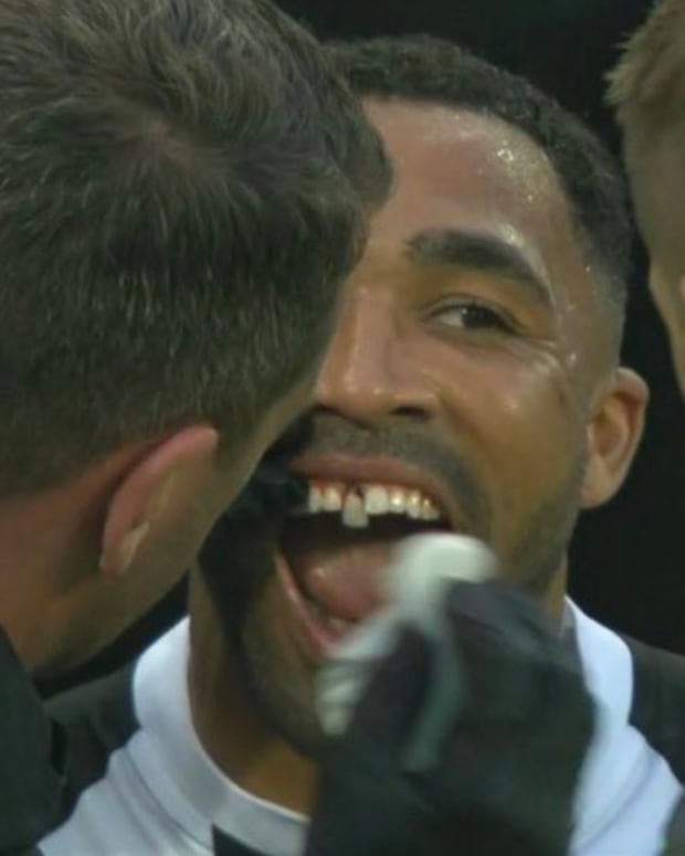 Newcastle United forward Callum Wilson pictured receiving dental treatment on a loose tooth during his side's 2-0 win over Arsenal in May 2022