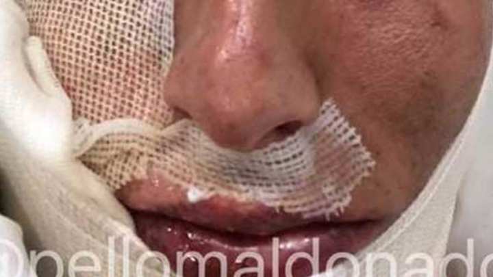 SE RECOMIENDA DISCRECIÓN |  Jürgen Damm sufre quemaduras en el rostro a causa de un explosivo