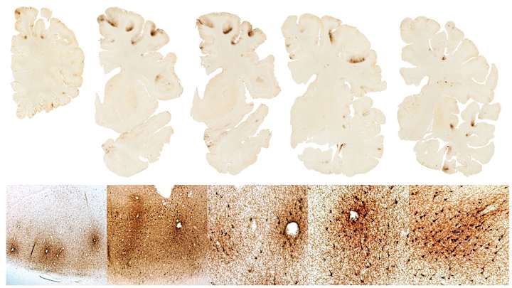 Here's What Boston University Researchers Saw When They Looked at Aaron Hernandez's Brain Here's What Boston University Researchers Saw When They Looked at Aaron Hernandez's Brain
