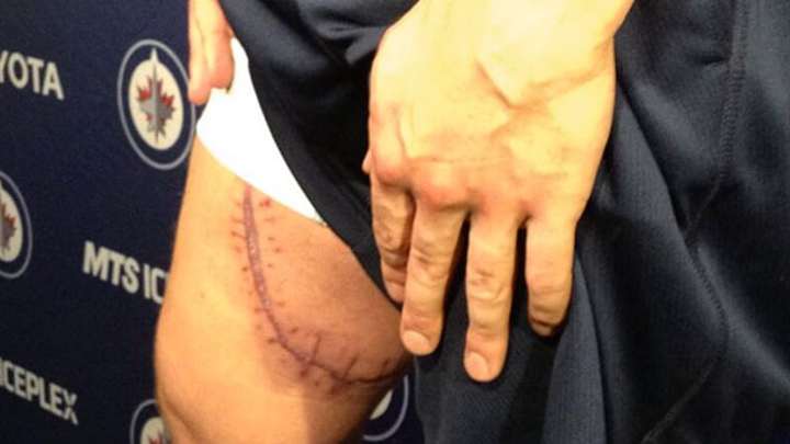Gruesome scar proves Zach Redmond of Jets is lucky to be alive Gruesome scar proves Zach Redmond of Jets is lucky to be alive