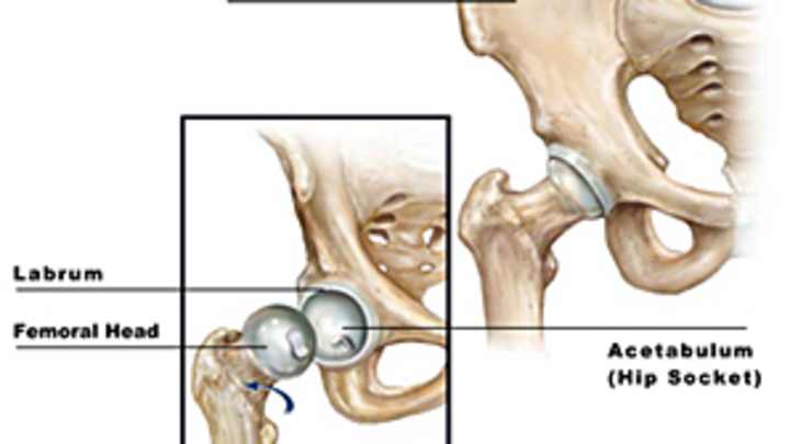 Expert: A-Rod's pending surgery necessary to prevent hip arthritis Expert: A-Rod's pending surgery necessary to prevent hip arthritis