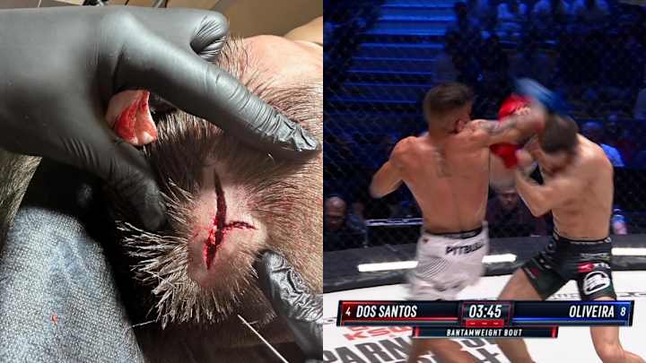 VIDEO: Gruesome Spinning-Elbow Splits Fighter's Head Open at KSW 84