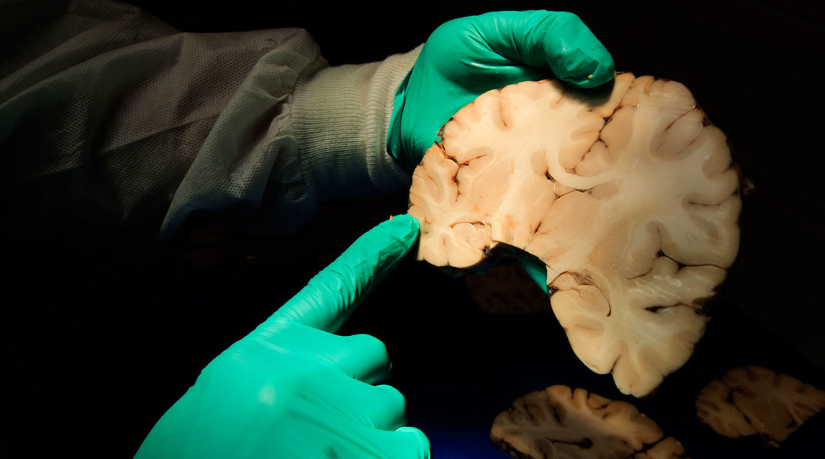 CTE-Brain.jpg