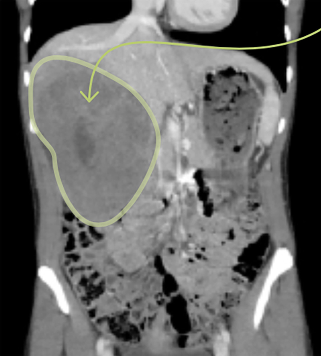 Cancer No. 3, a cantaloupe-sized lesion on Grunewald's liver, was surgically removed.