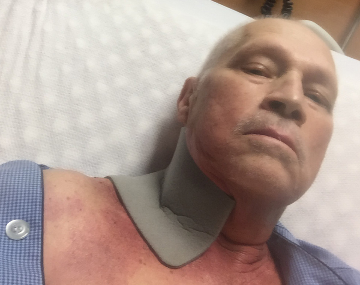 Receiving teatment for radiation burns in 2016.