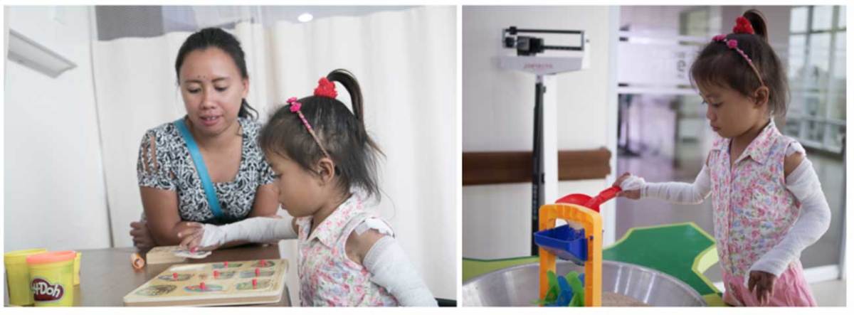 Jocy, a patient who underwent surgery for severe burns at the Tebow CURE hospital in the Philippines.