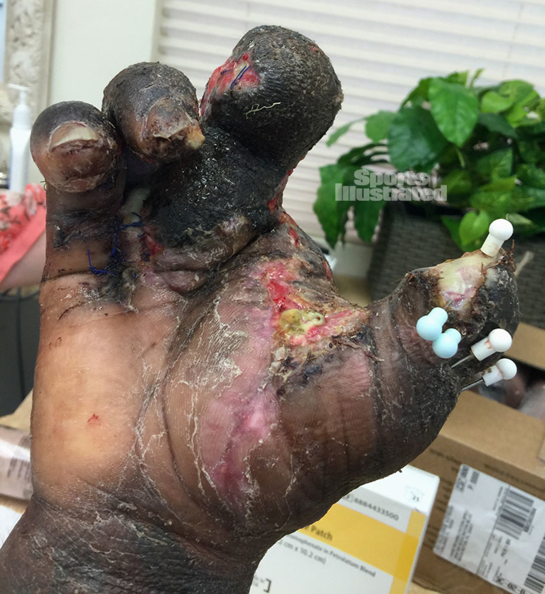 NFL Star Jason Pierre-Paul Shared INCREDIBLY Graphic Photos Of His Shredded  Hand To Remind People Of Fireworks Safety