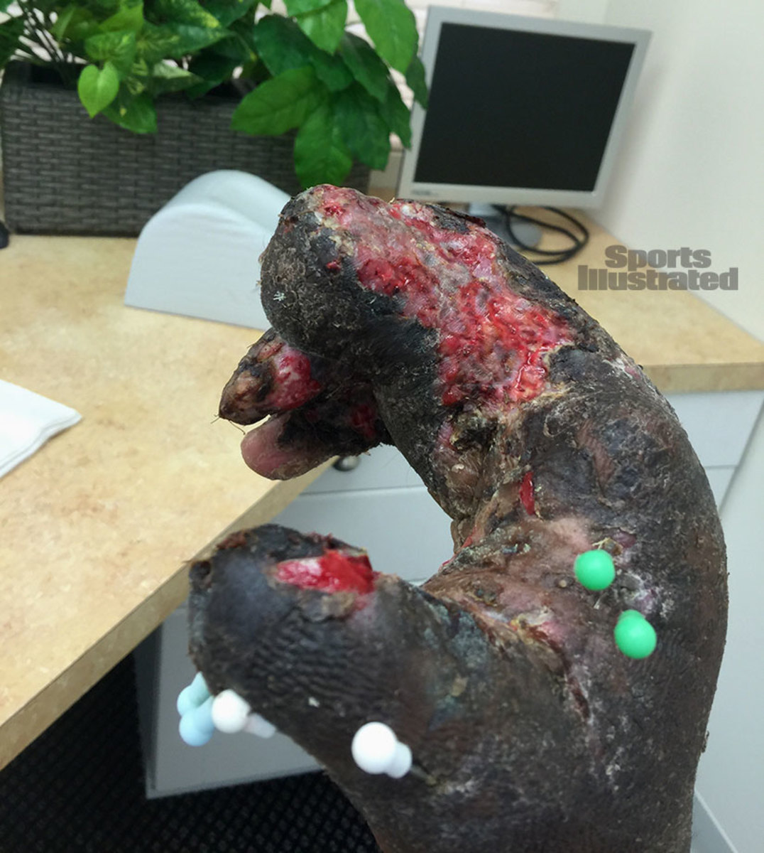 Jason Pierre-Paul shares graphic photos of his fireworks hand injury