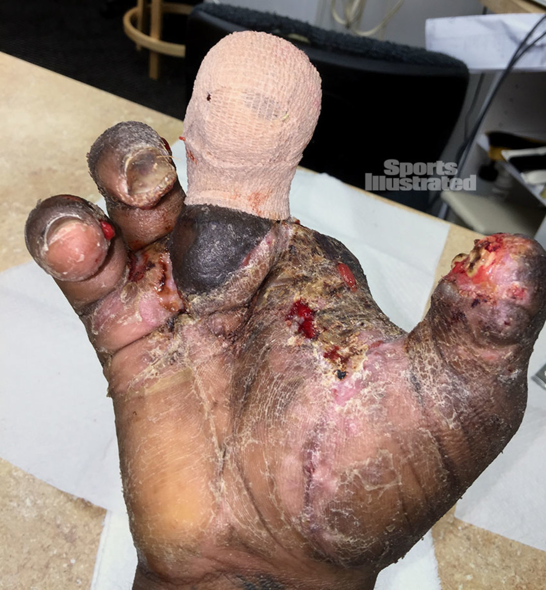 Jason Pierre-Paul shares graphic photos of his fireworks hand injury