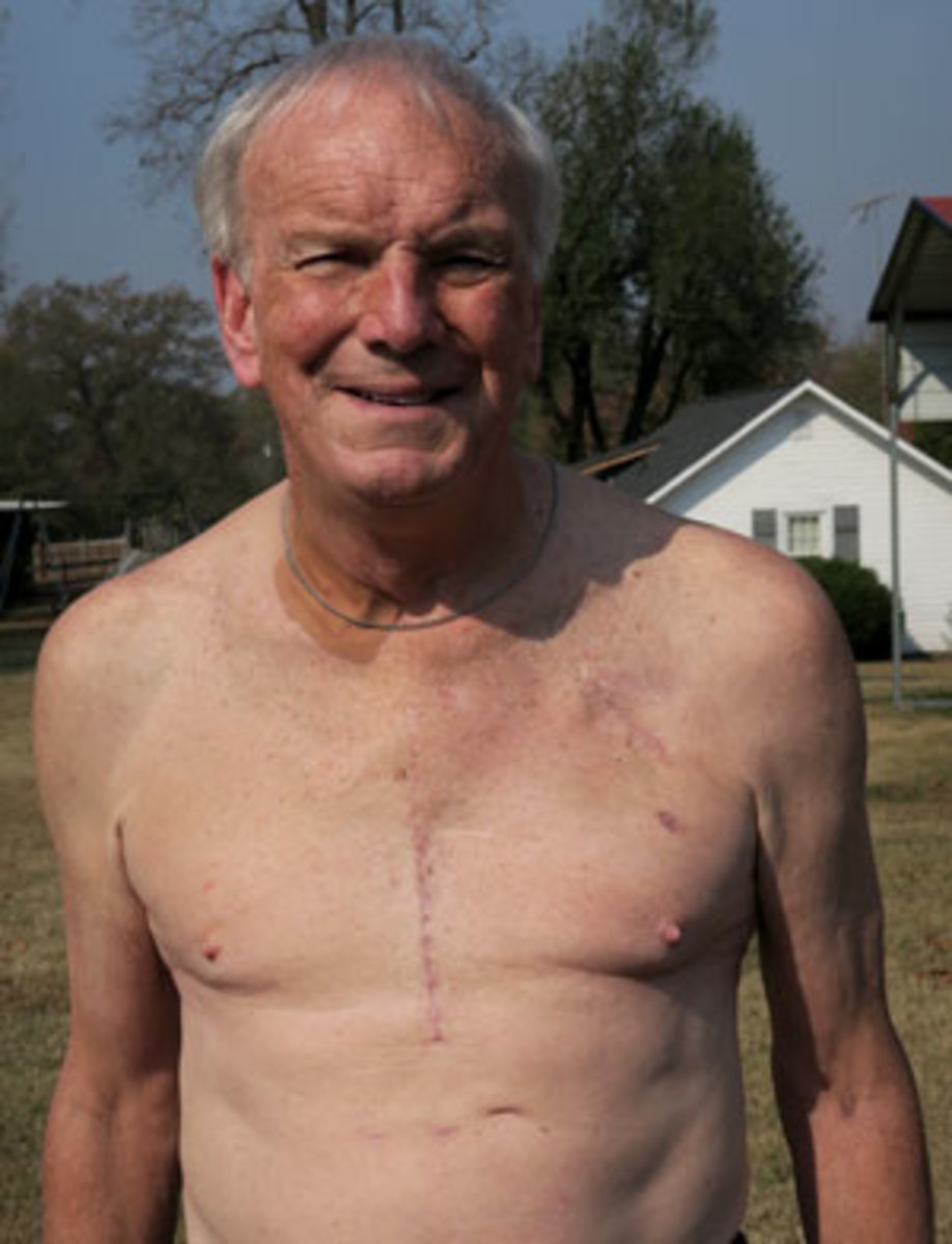 Wyche shows off his scar following heart transplant surgery.