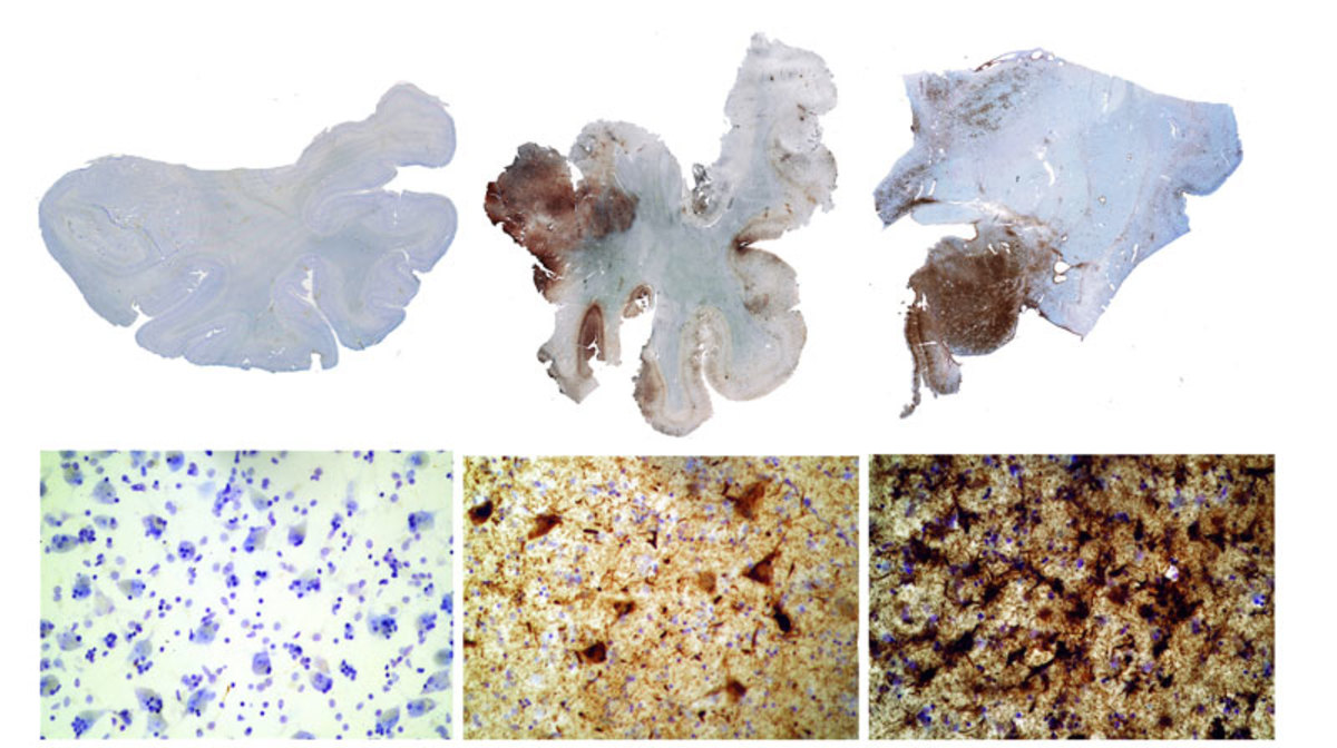 Three brains studied by the Boston University researchers: On the left, a control subject showing no signs of CTE. In the center, the brain of NFL linebacker John Grimsley, who died in 2008. The brown areas indicate the presence of tau. On the right, a former boxer who had suffered sever dementia shows the highest prevalence of tau. (Boston University)