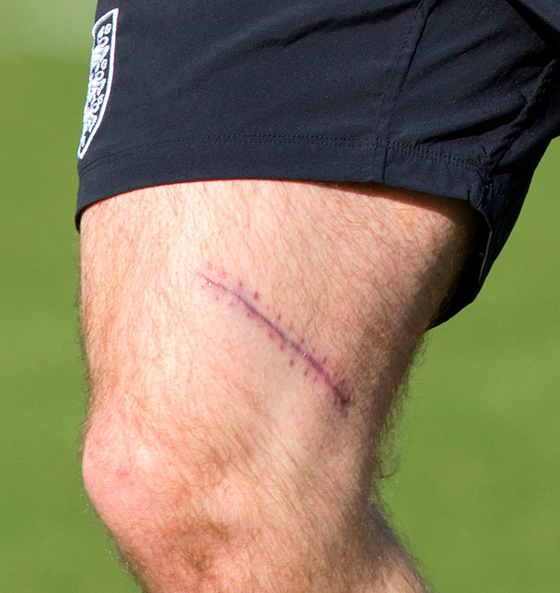 2012-wayne-rooney-surgery-scar.jpg