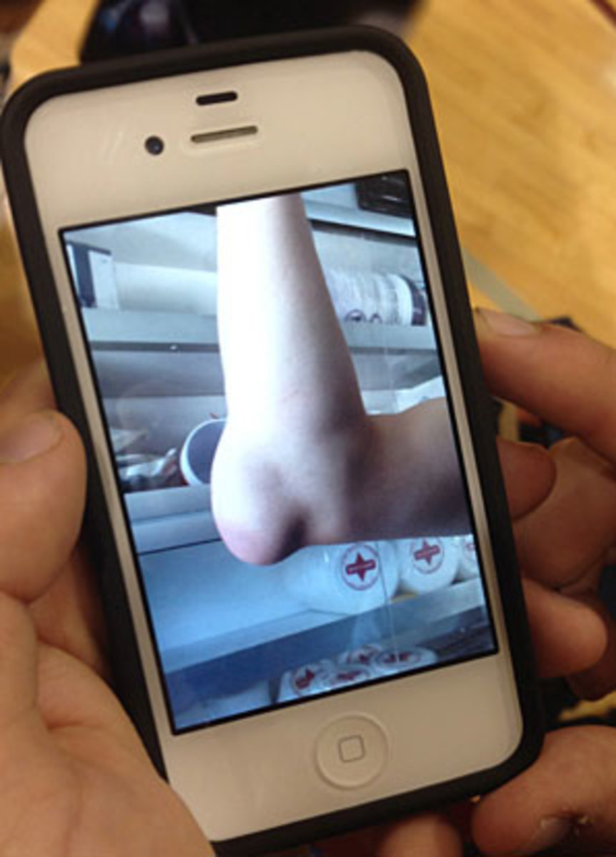 Jacob Hirschmann's swollen elbow was a painful reminder of how overmatched Eberlein was.