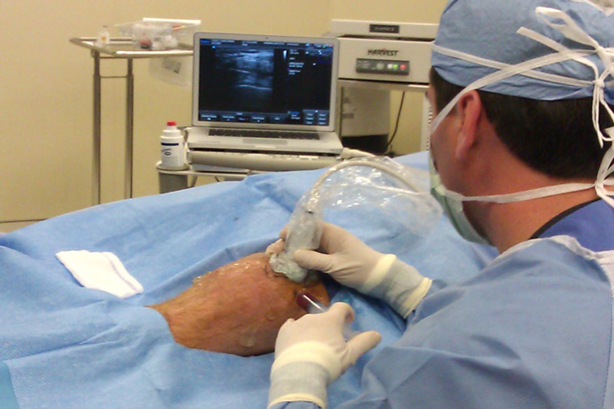 Dr. Josh G. Hackel of the Andrews Institute performs  a bone marrow aspirate injection to an arthritic knee under ultrasound guidance. (Courtesy of the Andrews Institute)