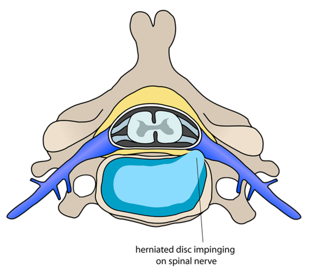 rothman-herinated-disc-625.jpg