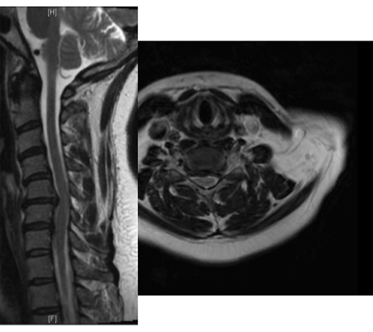 rothman-herinated-disc-625-xray.jpg