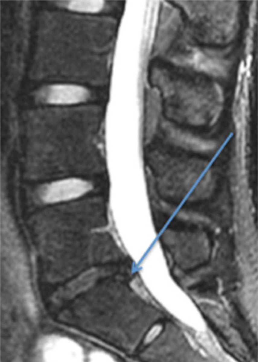 Figure 2: An MRI image demonstrating a herniated lumbar intervertebral disc.