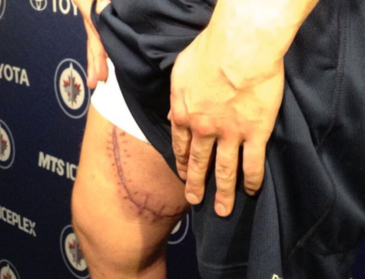 Zach Redmond of the Winnipeg Jets showed off his scar after a skate cut his femoral artery