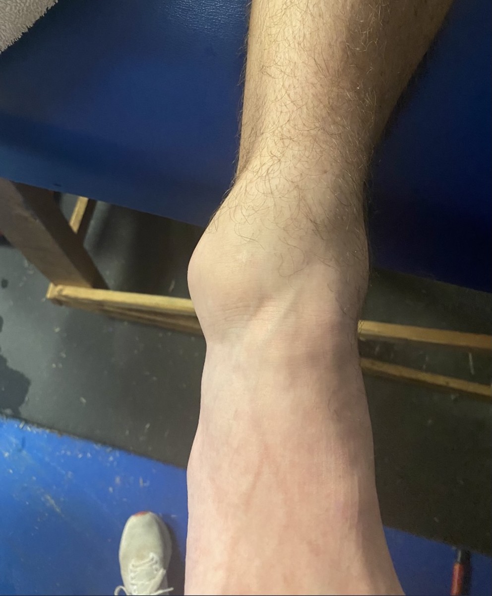 Ty Simpson’s ankle in a picture he sent the day before Westview’s playoff game at South Gibson.