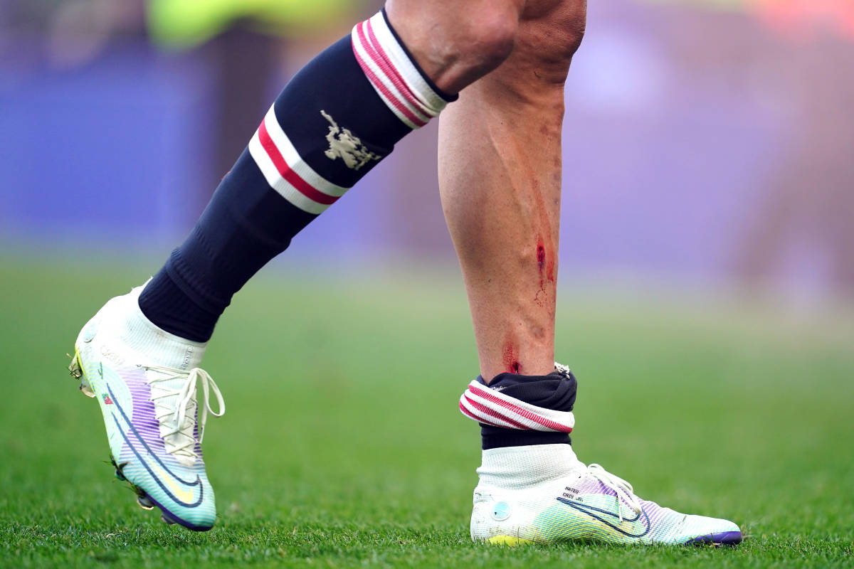 Cristiano Ronaldo's left leg is pictured with a studmark in it after Manchester United's 1-0 loss at Everton in April 2022