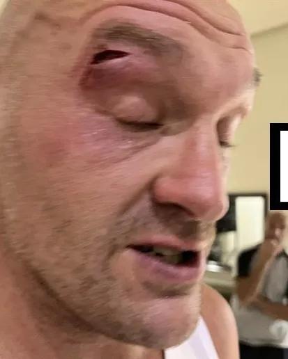 Tyson Fury suffers a severe cut above his eye, postponing the undisputed heavyweight title fight with Oleksandr Usyk.